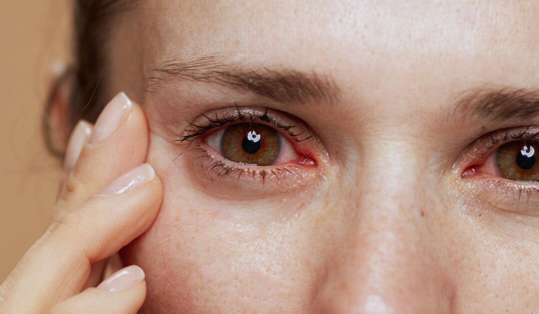 Dry Eye Syndrome: Symptoms, Causes, and Treatment